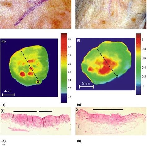 in vivo thickness measurement of basal cell carcinoma|In vivo thickness measurement of basal cell carcinoma and actinic .